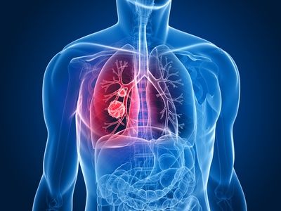 Osimertinib, ya disponible para el tratamiento adyuvante de pacientes con cáncer de pulmón no microcítico en estadio temprano con mutación EGFR